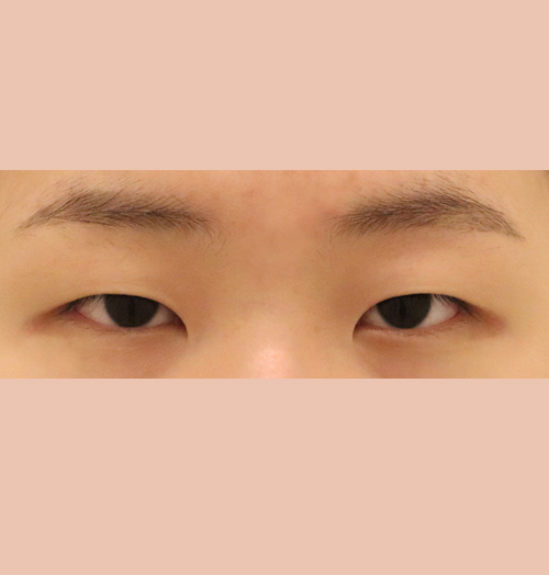 치료 전 이미지