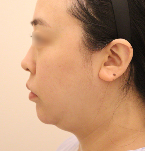 치료 전 이미지