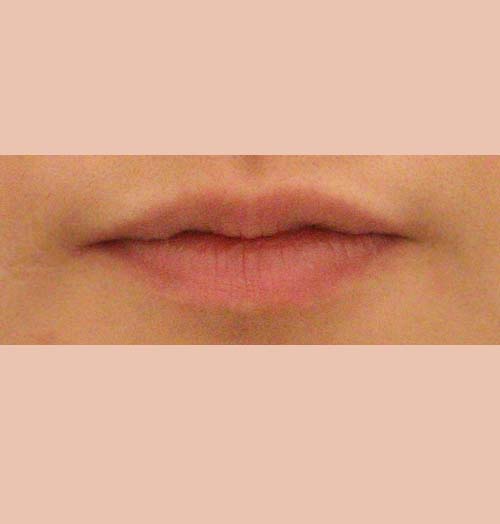 치료 전 이미지