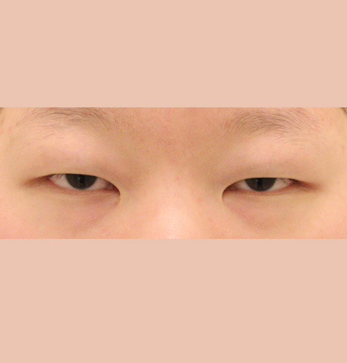 치료 전 이미지