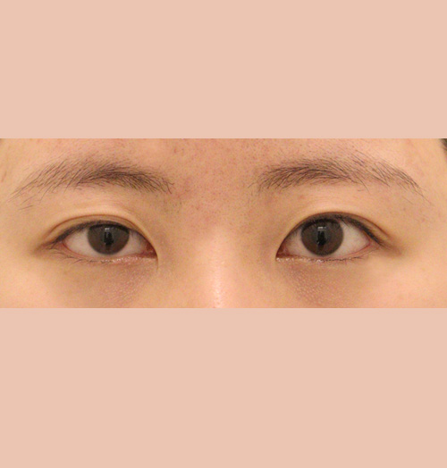 치료 전 이미지