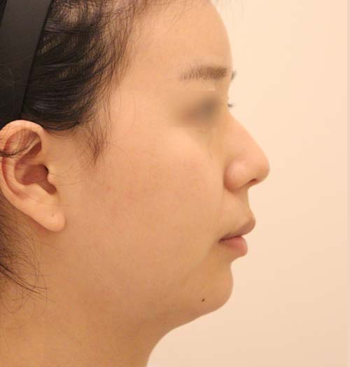 치료 전 이미지