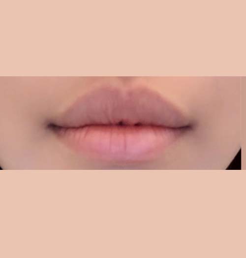 치료 전 이미지