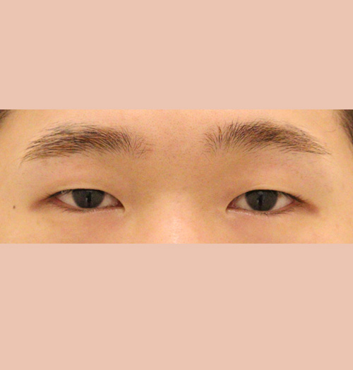 치료 전 이미지